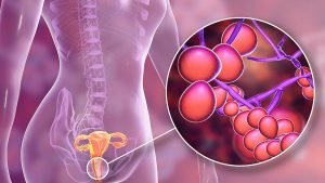 UVCs against Candida Auris